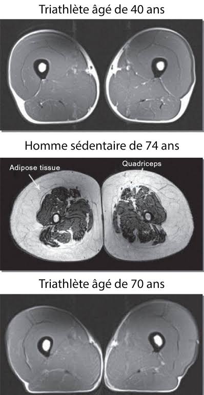 Comparaison illustrative de coupes IRM de quadriceps chez un triathlète de 40 ans, un homme sédentaire de 74 ans et un triathlète de 70 ans